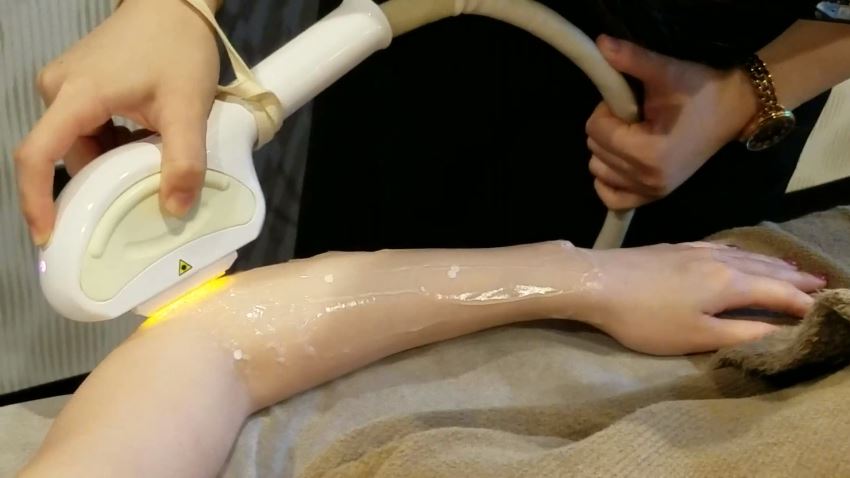 脱毛機を腕の毛に照射
