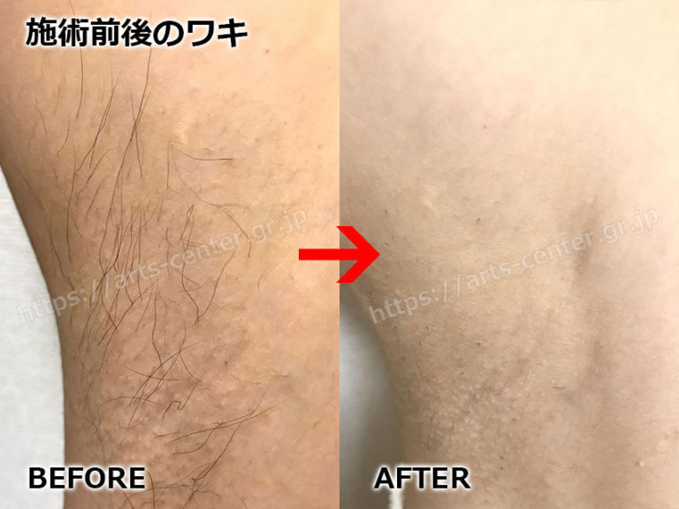 ジェイエステ（ワキ・腕・足脱毛）の写真＆評価を突撃インタビュー